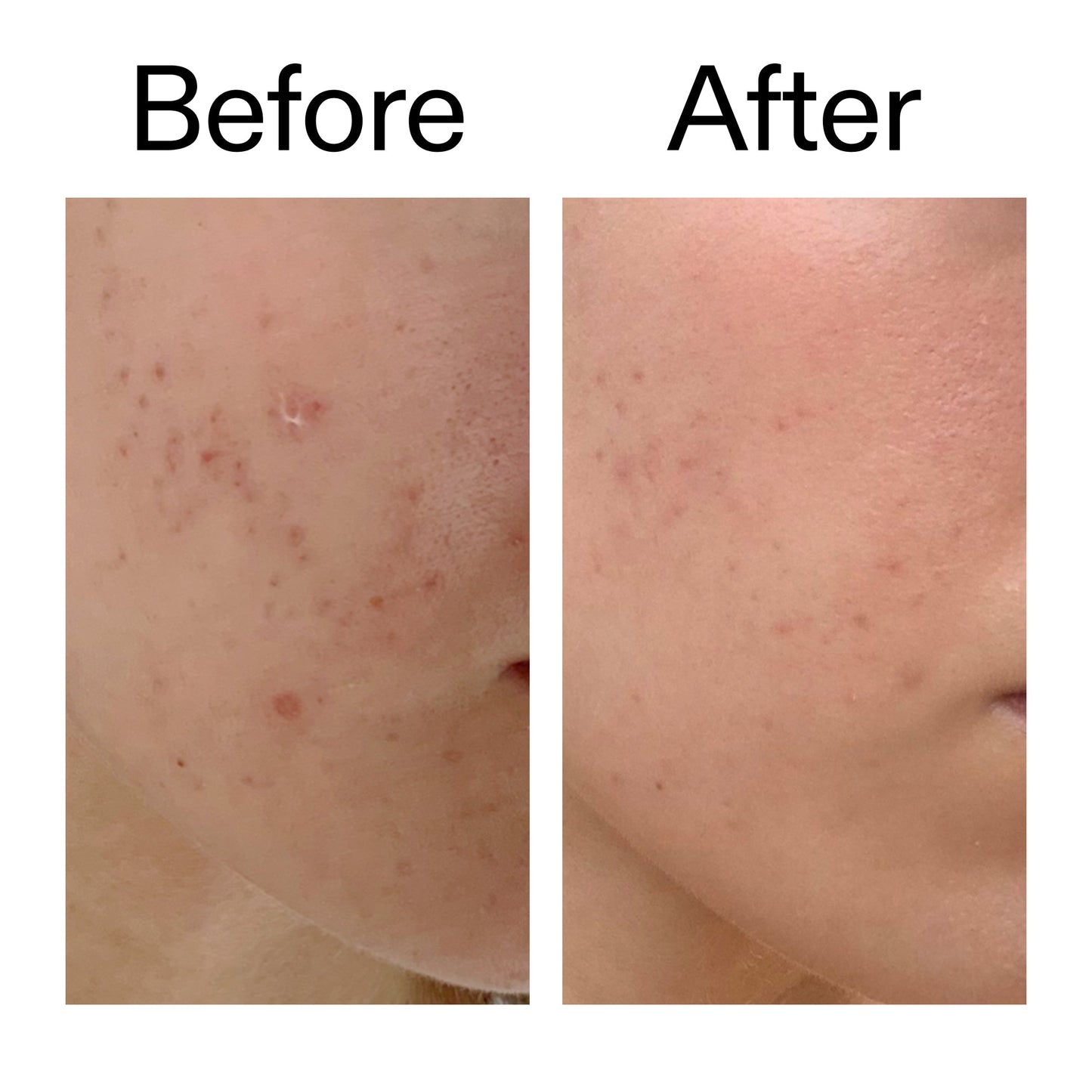 mandelic-acid-treatment-p3 Mandelic_Acid_Treatment_Before_After_2000x2000_4885ac6e-c5d7-4279-a72a-1417af7dce35.jpg