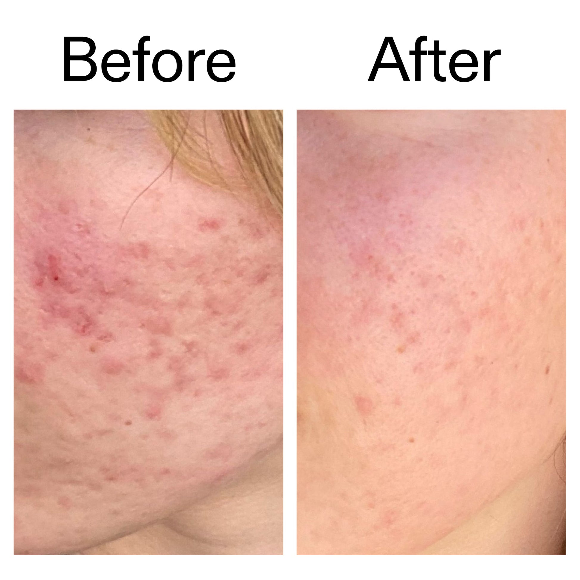 10-azelaic-acid-serum-for-redness-relief-f1 Azealic_Acid_Serum_B_A_Ppage_2000_x_2000.jpg