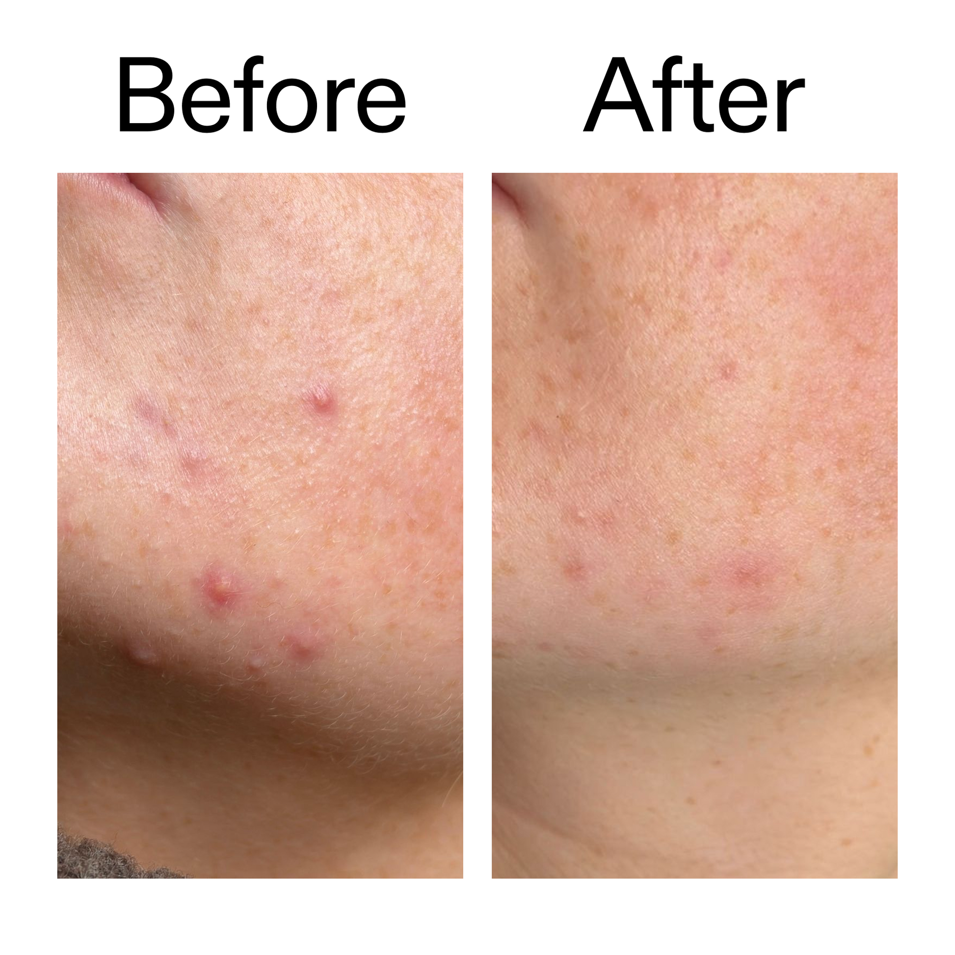 10-azelaic-acid-serum-for-redness-relief-f1 B_A_1_PPAGE.png