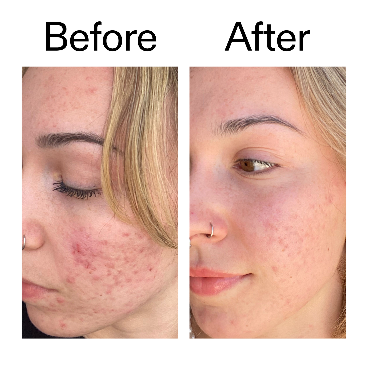 10-azelaic-acid-serum-for-redness-relief-f1 B_A_2_PPAGE.png