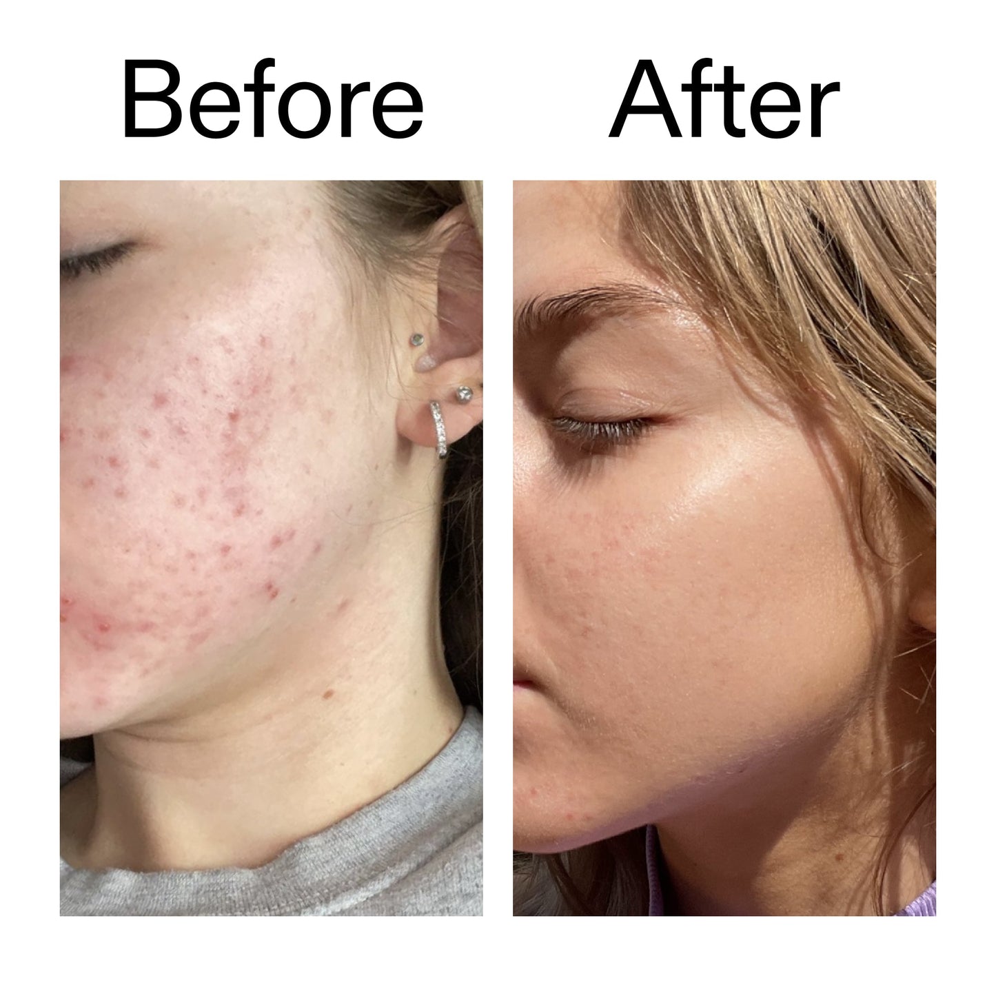 beta-hydroxy-acid-bha-serum-s1 Beta_Hydroxy_Acid_Serum_Before_After_2000x2000_96fda3e5-938d-49ef-bcf2-a0fa6ece4e2c.jpg