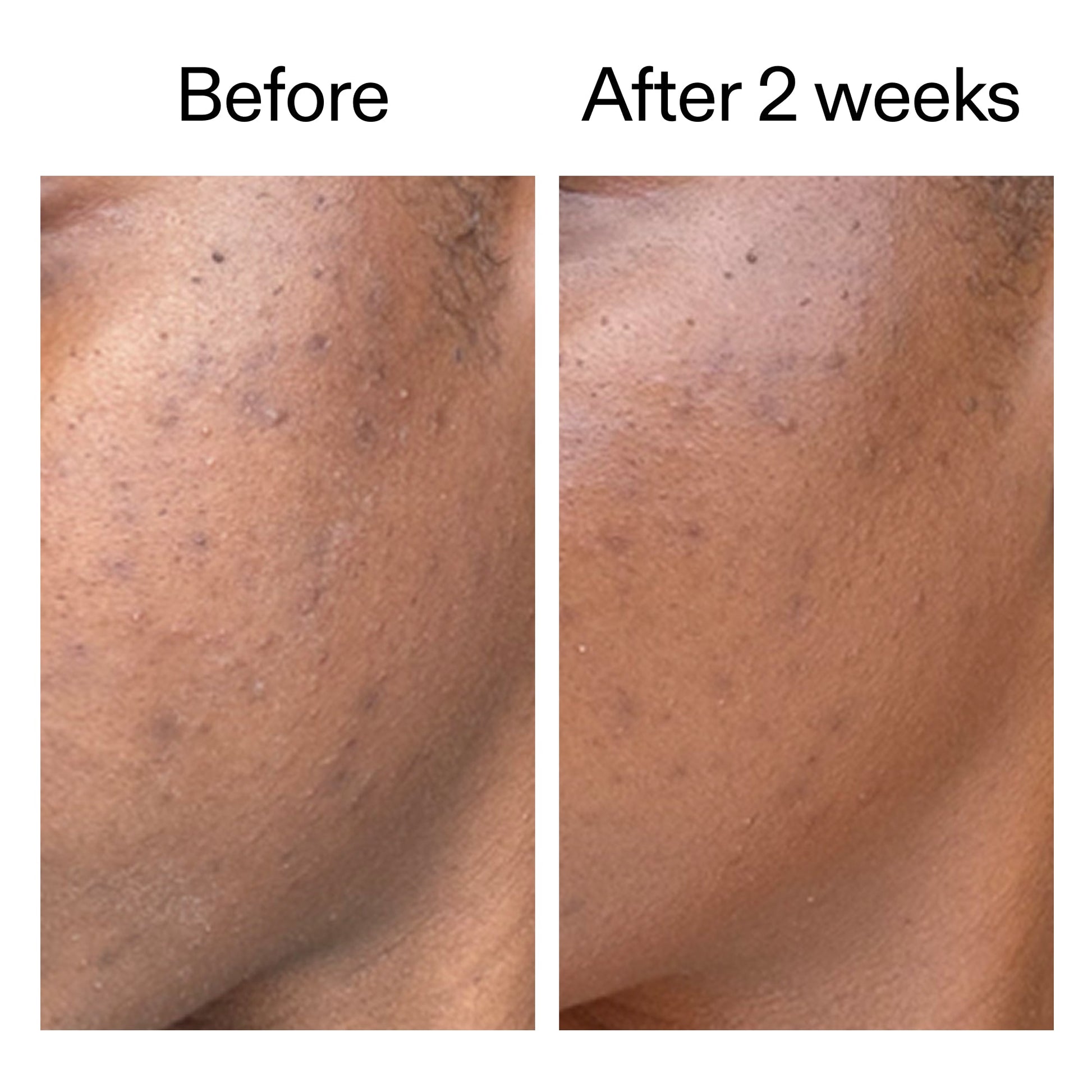 360-acne-clearing-duo-l2 DIOICB_A2000x2000.jpg