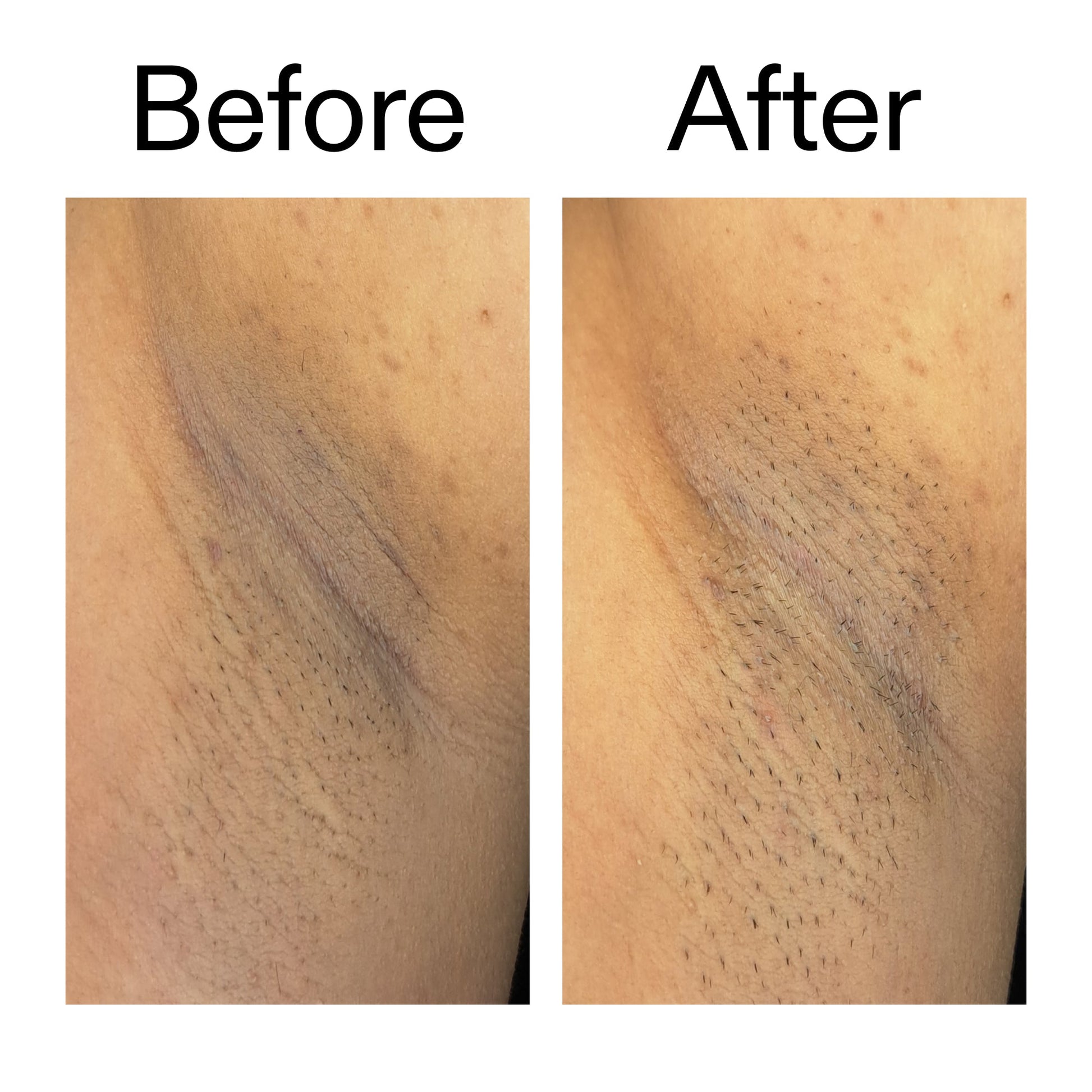glycolic-acid-exfoliating-body-stick-duo-y0 Glycolic_Acid_Exfoliating_Body_Stick_Before_After_V3_2000x2000_ea919cd9-1439-4a46-82a0-76200eb5bb42.jpg