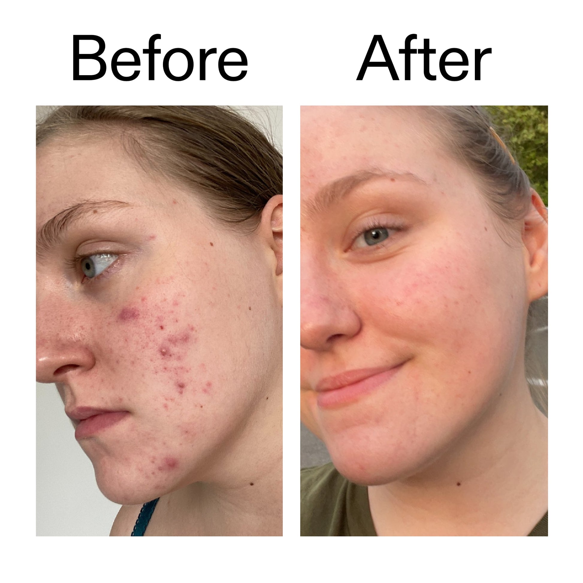 glycolic-acid-toner-g5 Glycolic_Acid_Toner_Before_After_2000x2000_49f0b9f7-e71b-4b2e-a8f8-2ea4b73247bb.jpg