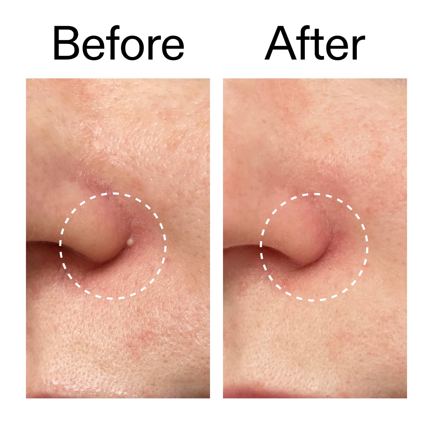 hydrocolloid-invisible-pimple-patches-pack-of-22-z0 Hydrocolloid_Invisible_Pimple_Patches_Before_After_2000x2000_b02aa37b-c78a-4682-91de-9135af5bb7df.jpg