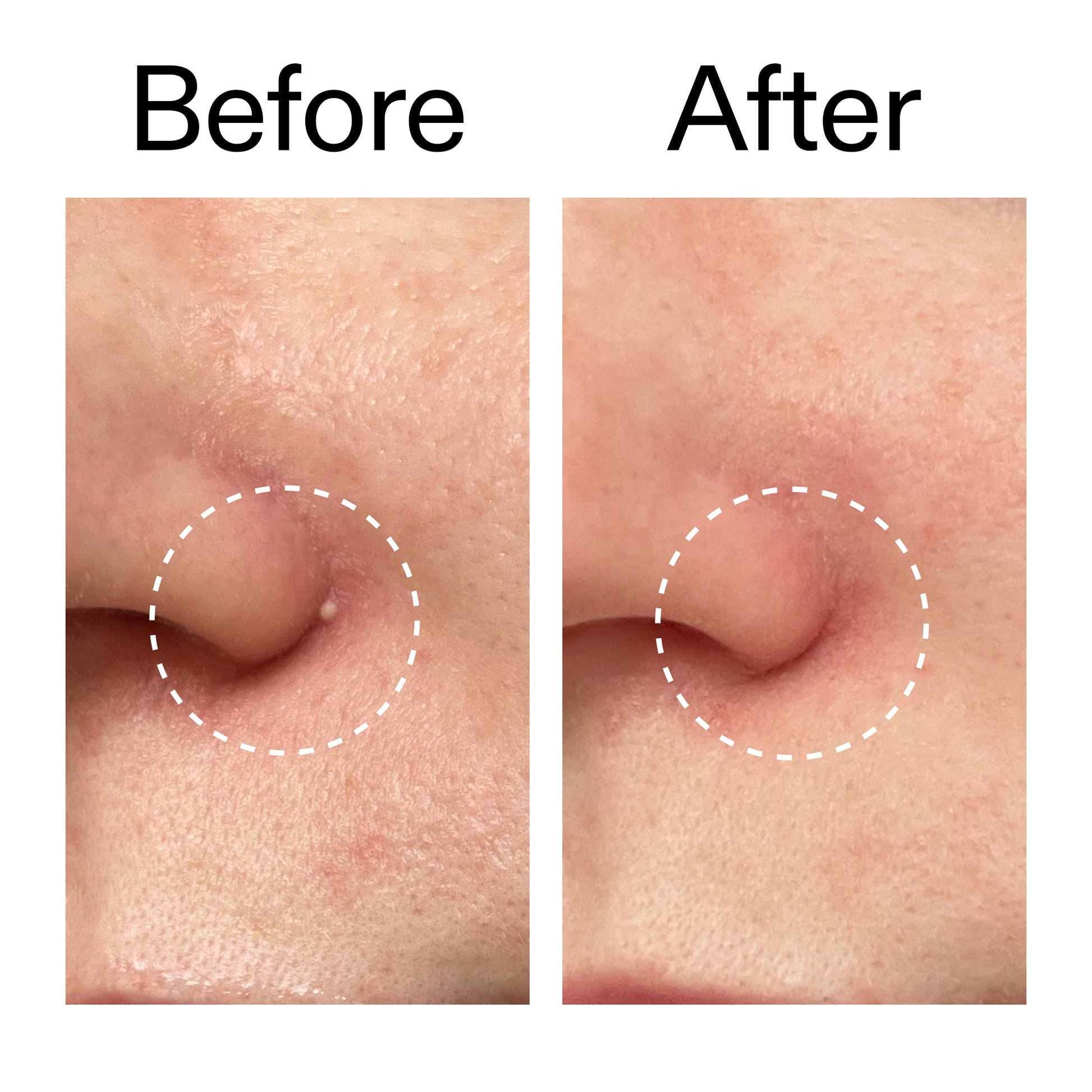 hydrocolloid-invisible-pimple-patches-pack-of-44-y3 Hydrocolloid_Invisible_Pimple_Patches_Before_After_2000x2000_b02aa37b-c78a-4682-91de-9135af5bb7df.jpg