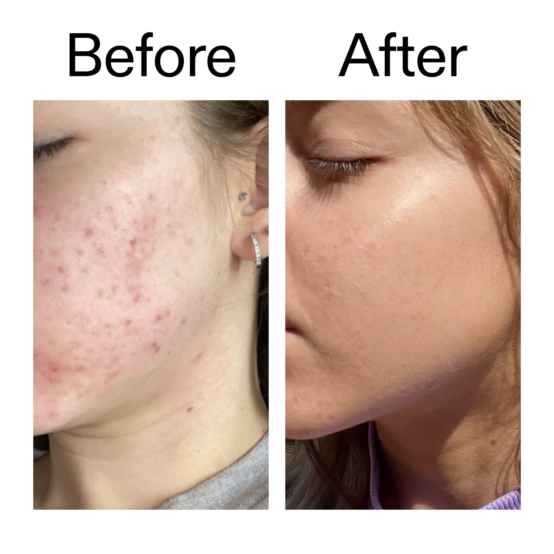 10-niacinamide-serum-duo-z2 Niacinamide_Serum_Before_After_2000x2000_bde32455-9e7d-448e-b053-bef41504f0a9.jpg