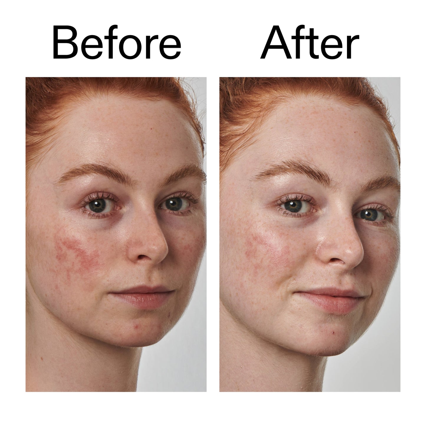 10-azelaic-acid-serum-for-redness-relief-f1 Redness_Relief_Serum_Before_After_2000x2000_3334dc9a-cce9-4e00-8aec-7ad89ca051f2.jpg