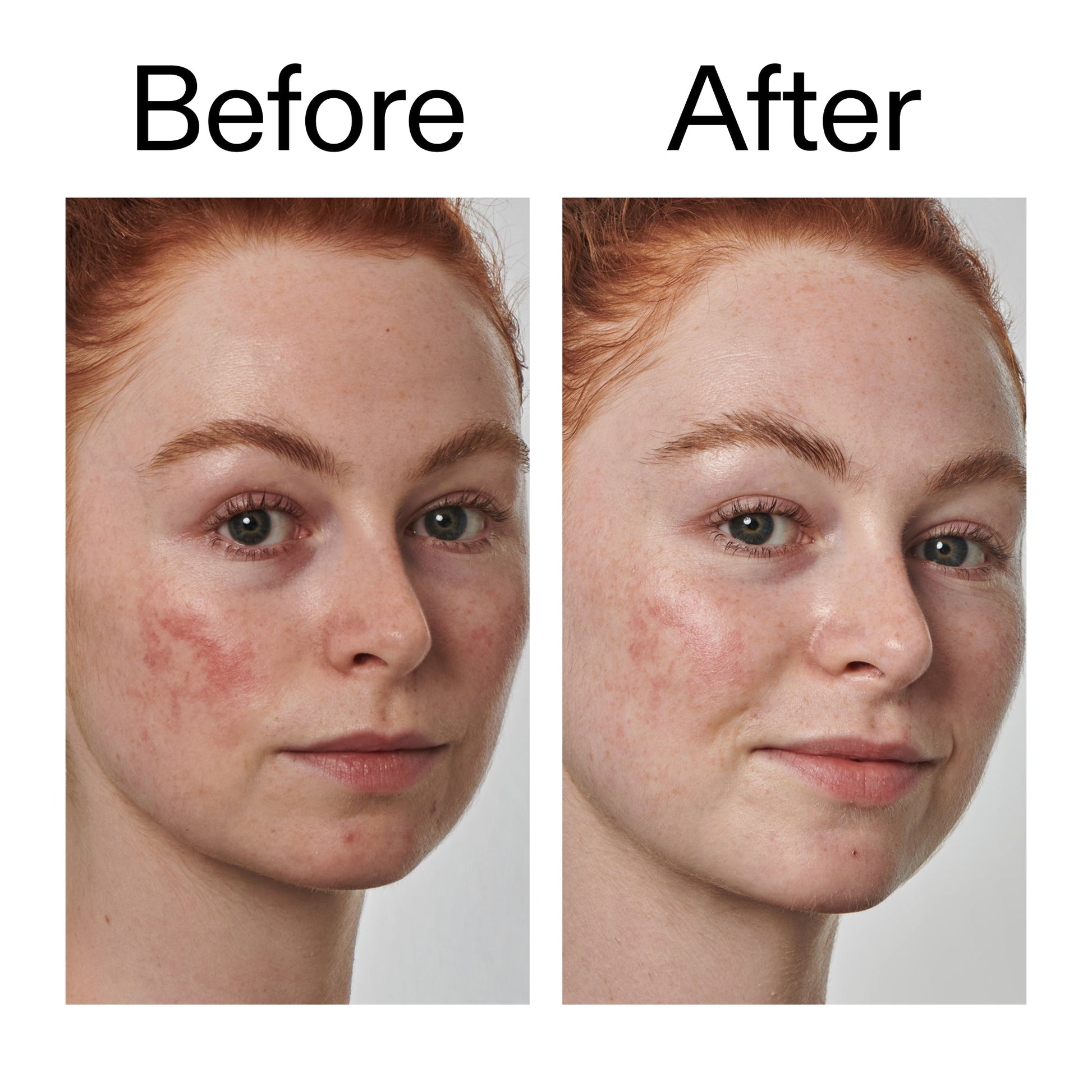 10-azelaic-acid-serum-for-redness-relief-f1 Redness_Relief_Serum_Before_After_2000x2000_3334dc9a-cce9-4e00-8aec-7ad89ca051f2.jpg