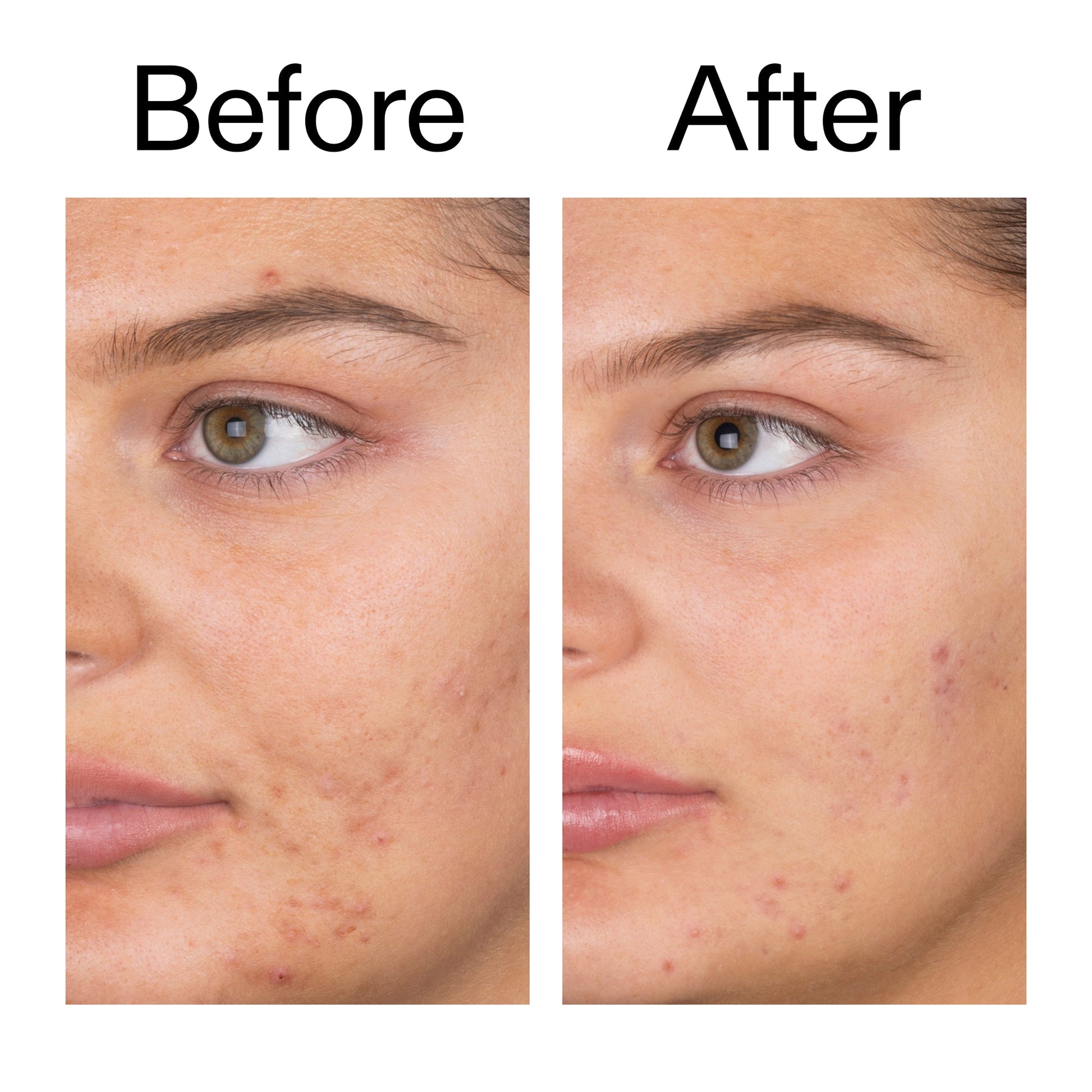 salicylic-acid-cleanser-duo-c7 Salicylic_Acid_Cleanser_-_150ml_Before_After_2000x2000_e7230494-853f-4b07-82b1-27669104c995.jpg