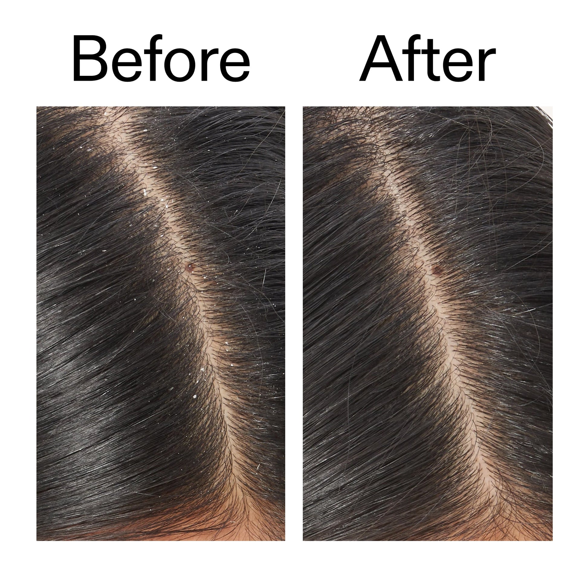 salicylic-acid-exfoliating-scalp-treatment-q6 Salicylic_Acid_Exfoliating_Scalp_Treatment_Before_After_V2_2000x2000_02bd61ad-42bf-490b-b3e3-7e04b2e8a673.jpg