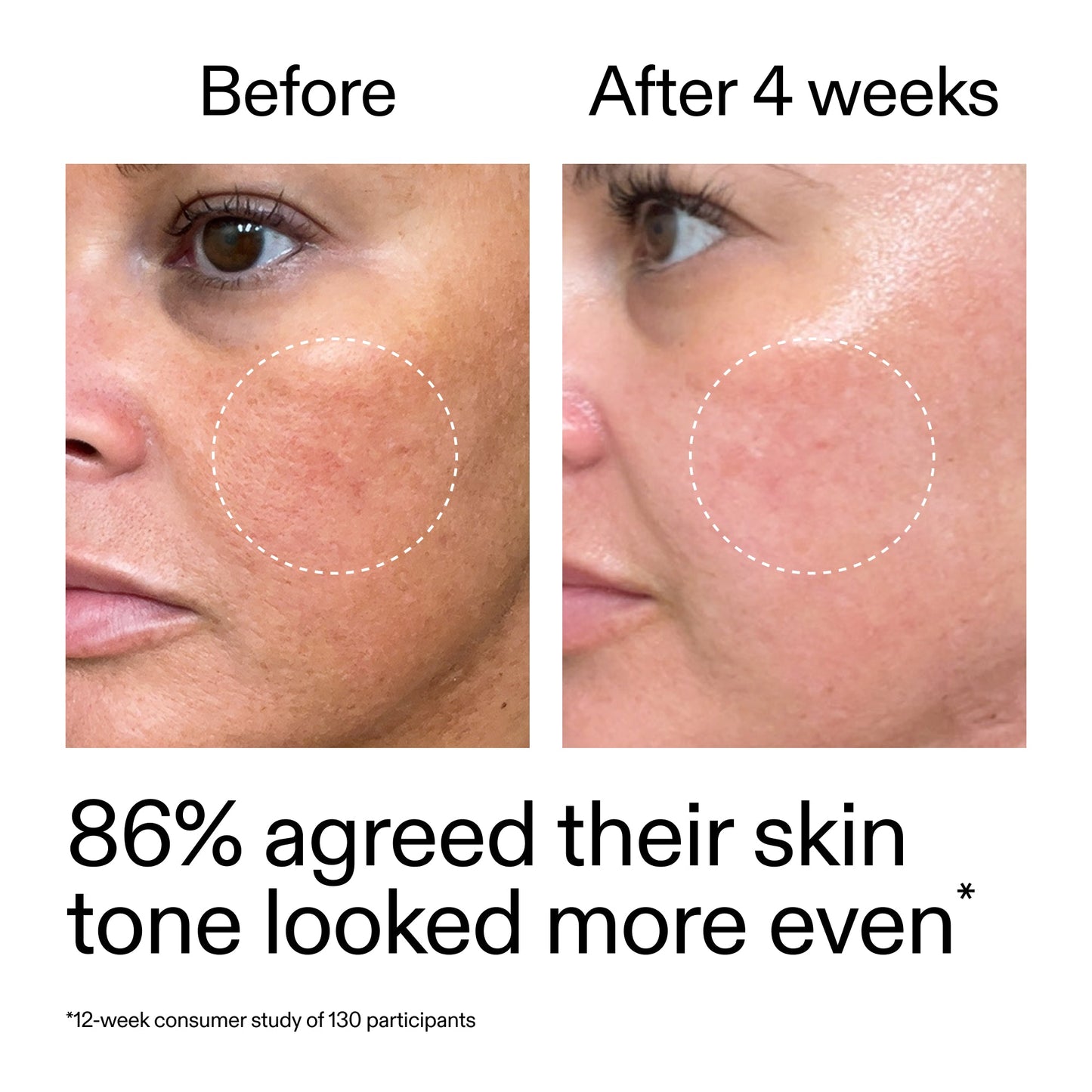 starter-retinol-serum-g0 StarterRetinol_BeforeAfter_Claim2_2000x2000_f5c9ecc0-8d76-429d-bef5-c3a61bcf5c09.jpg