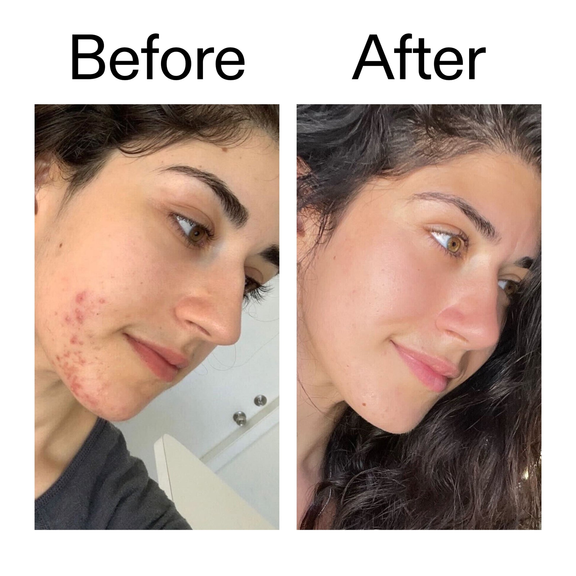 succinic-acid-acne-treatment-a8 Succinic_Acid_Treatment_Before_After_2000x2000_6a5f0054-2f58-4433-9314-0dc72c9bdd3b.jpg