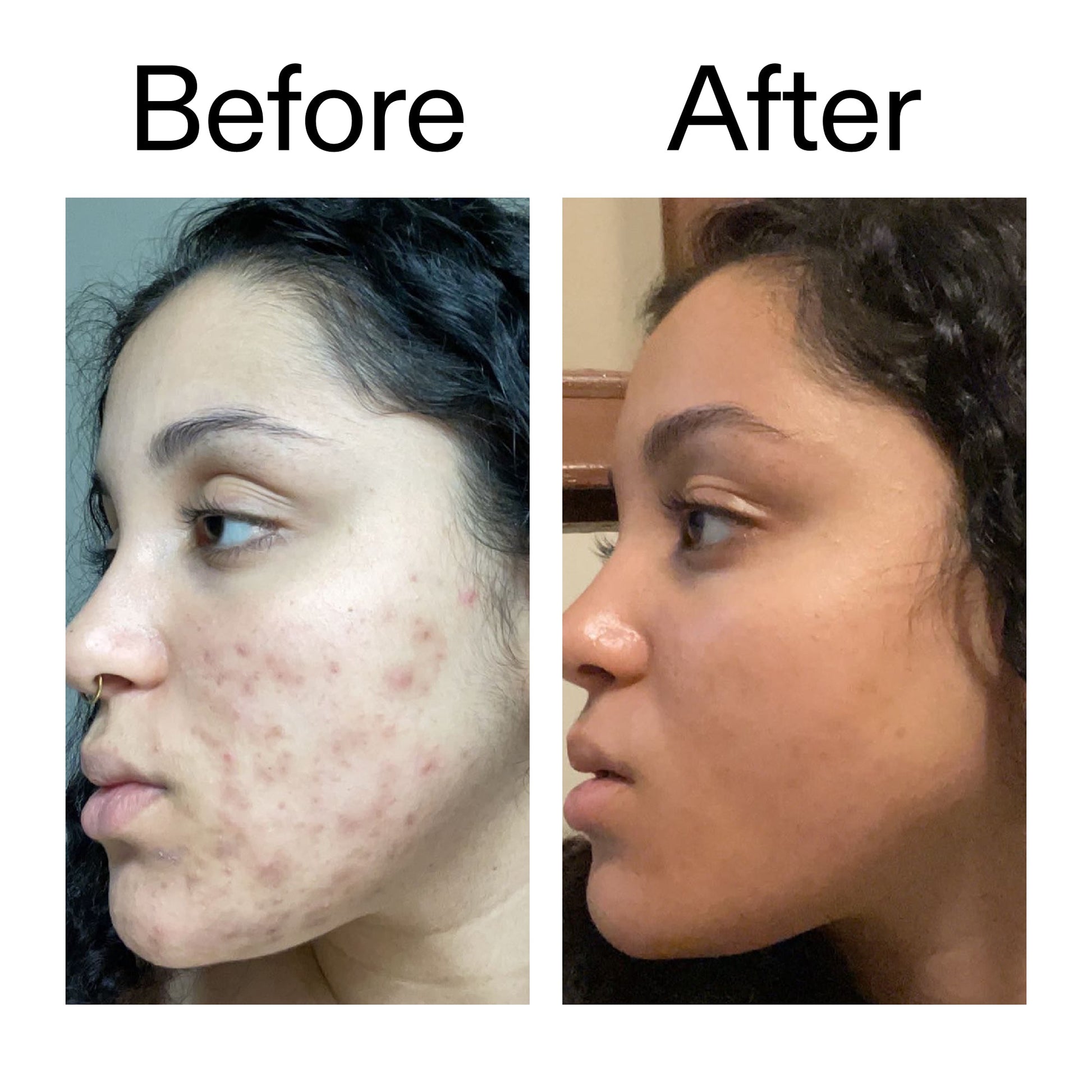 tranexamic-acid-serum-t2 Tranexamic_Acid_Serum_Before_After_2000x2000_98ebc8be-77b0-4843-8a22-90790ebe918b.jpg